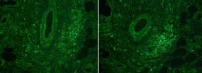 Prognostic significance of lymphocytic foci composition in minor salivary gland biopsies for severe disease flare and severity in Sjögren’s syndrome: a 3-year follow-up cohort study